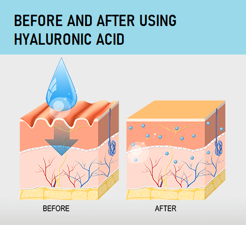 hyaluronic acid