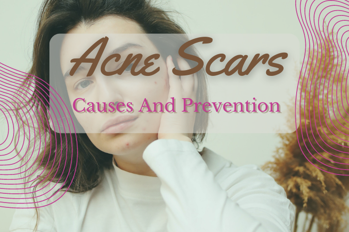 acne scar causes and prevention